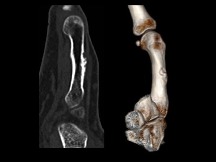 Figure 2 for case Malignant myoepithelial tumour of soft tissue